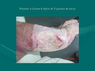 Paciente 3: Lesión 4: Inicio de 3ª postura de larvas 