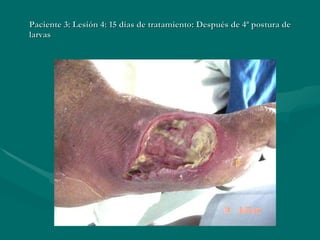 Paciente 3: Lesión 4: 15 días de tratamiento: Después de 4ª postura de larvas 