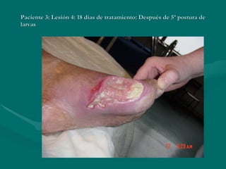 Paciente 3: Lesión 4: 18 días de tratamiento: Después de 5ª postura de larvas 