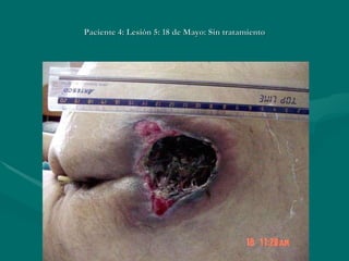 Paciente 4: Lesión 5: 18 de Mayo: Sin tratamiento 