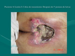 Paciente 4: Lesión 5: 3 días de tratamiento: Después de 1ª postura de larvas 