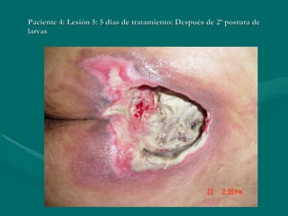 Paciente 4: Lesión 5: 5 días de tratamiento: Después de 2ª postura de larvas 