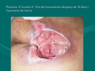 Paciente 4: Lesión 5:  Fin del tratamiento después de 14 días y 4 posturas de larvas 