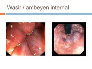 Wasir / ambeyen internal