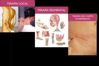 TERAPIA LOCAL

                TERAPIA SEGMENTAL
                                    TERAPIA DEL CAMPO
                                       INTERFERENTE




                                                        7
 