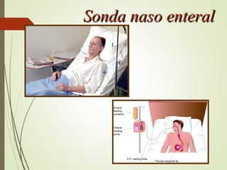 Sonda naso enteralSonda naso enteral
 