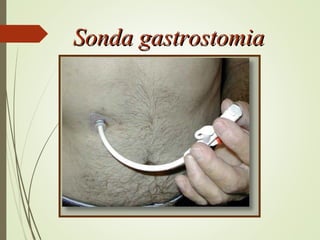 Sonda gastrostomiaSonda gastrostomia
 