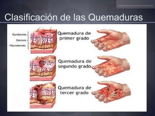 Clasificación de las Quemaduras
 