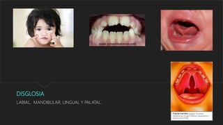 DISGLOSIA
LABIAL, MANDIBULAR, LINGUAL Y PALATAL.
 
