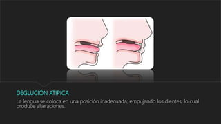 DEGLUCIÓN ATIPICA
La lengua se coloca en una posición inadecuada, empujando los dientes, lo cual
produce alteraciones.
 