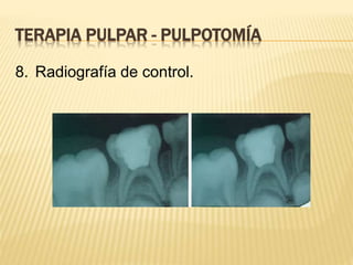 8. Radiografía de control.
TERAPIA PULPAR - PULPOTOMÍA
 