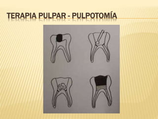 TERAPIA PULPAR - PULPOTOMÍA
 