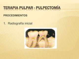 PROCEDIMIENTOS
1. Radiografía inicial
TERAPIA PULPAR - PULPECTOMÍA
 