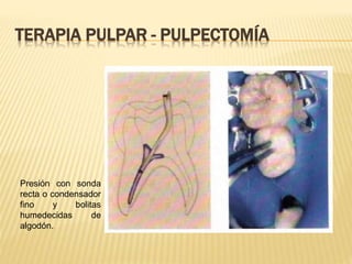 Presión con sonda
recta o condensador
fino y bolitas
humedecidas de
algodón.
TERAPIA PULPAR - PULPECTOMÍA
 