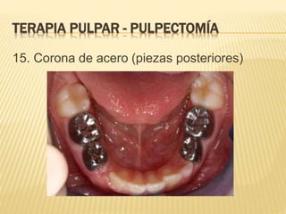 15. Corona de acero (piezas posteriores)
TERAPIA PULPAR - PULPECTOMÍA
 