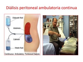 Diálisis peritoneal ambulatoria continua
 