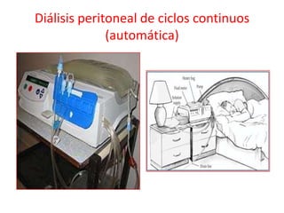 Diálisis peritoneal de ciclos continuos
(automática)
 