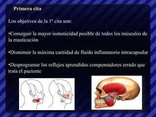 Primera cita

Los objetivos de la 1ª cita son:

•Conseguir la mayor isotonicidad posible de todos los músculos de
la masticación

•Disminuir la máxima cantidad de fluido inflamatorio intracapsular

•Desprogramar los reflejos aprendidos compensadores errado que
traía el paciente
 
