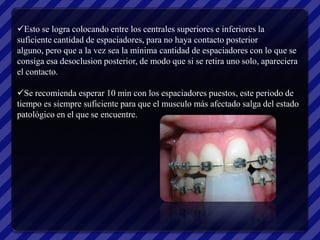 Esto se logra colocando entre los centrales superiores e inferiores la
suficiente cantidad de espaciadores, para no haya contacto posterior
alguno, pero que a la vez sea la mínima cantidad de espaciadores con lo que se
consiga esa desoclusion posterior, de modo que si se retira uno solo, apareciera
el contacto.

Se recomienda esperar 10 min con los espaciadores puestos, este periodo de
tiempo es siempre suficiente para que el musculo más afectado salga del estado
patológico en el que se encuentre.
 