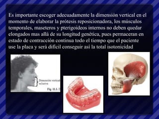 Es importante escoger adecuadamente la dimensión vertical en el
momento de elaborar la prótesis reposicionadora, los músculos
temporales, maseteros y pterigoideos internos no deben quedar
elongados mas allá de su longitud genética, pues permaceran en
estado de contracción continua todo el tiempo que el paciente
use la placa y será difícil conseguir así la total isotonicidad
 