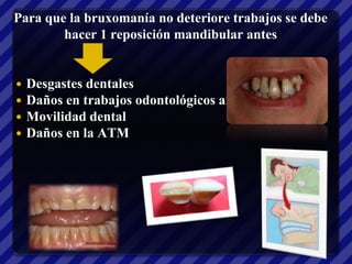 Para que la bruxomanía no deteriore trabajos se debe
        hacer 1 reposición mandibular antes


   Desgastes dentales
   Daños en trabajos odontológicos anteriores
   Movilidad dental
   Daños en la ATM
 