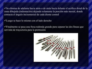 Se elimina de adelante hacia atrás o de atrás hacia delante el acrílico distal de la
zona dibujada (indentación) dejando solamente la porción más mesial, donde
contacta el ángulo incisomesial de cada diente central

Luego se hace lo mismo con el lado derecho

Finalmente se pasa una fresa redonda grande para separar las dos líneas que
servirán de trayectoria para la protrusión
 