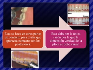 Esto se hace en otras partes    Esta debe ser la única
de contacto para evitar que       razón por la que la
 aparezca contacto con los     dimensión vertical de la
        posteriores.             placa se debe variar.
 