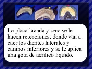 La placa lavada y seca se le
hacen retenciones, donde van a
caer los dientes laterales y
caninos inferiores y se le aplica
una gota de acrílico liquido.
 