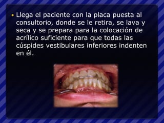    Llega el paciente con la placa puesta al
    consultorio, donde se le retira, se lava y
    seca y se prepara para la colocación de
    acrílico suficiente para que todas las
    cúspides vestibulares inferiores indenten
    en él.
 