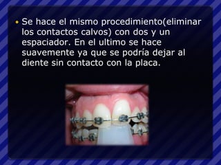    Se hace el mismo procedimiento(eliminar
    los contactos calvos) con dos y un
    espaciador. En el ultimo se hace
    suavemente ya que se podría dejar al
    diente sin contacto con la placa.
 