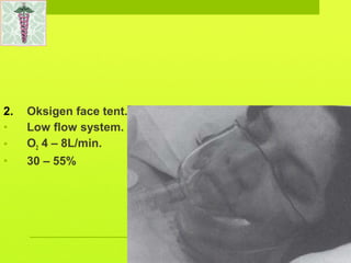 2. Oksigen face tent.
• Low flow system.
• O2 4 – 8L/min.
• 30 – 55%
 
