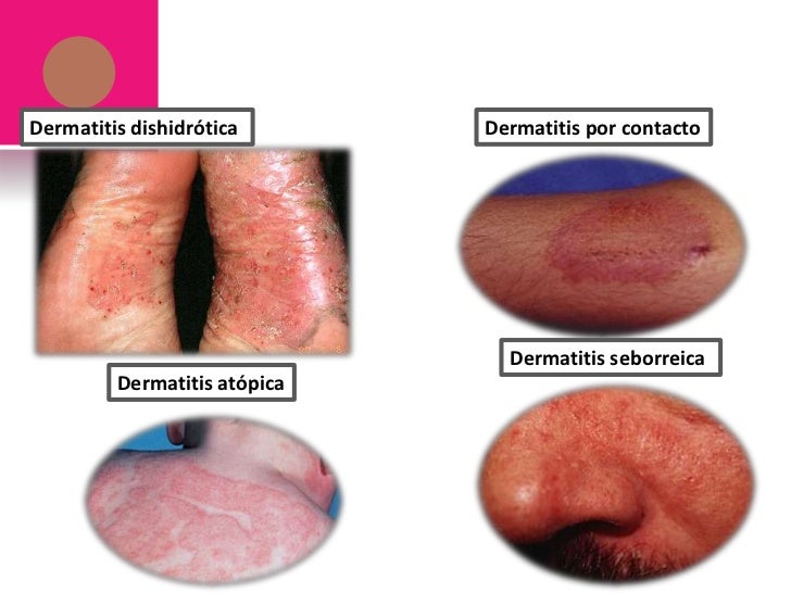 El lavado del niño con atopicheskim por la dermatitis