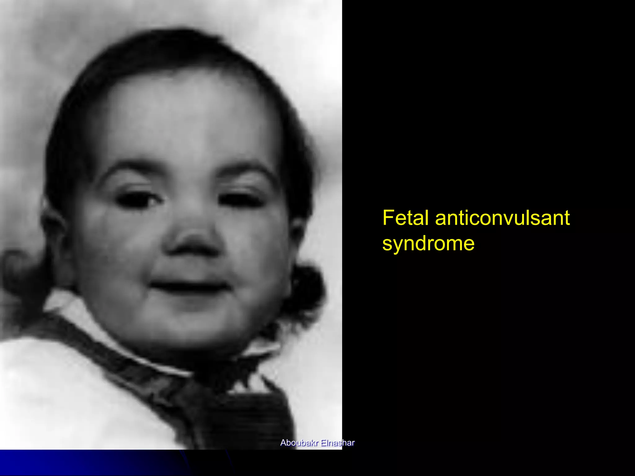 Fetal anticonvulsant
syndrome
Aboubakr Elnashar
 