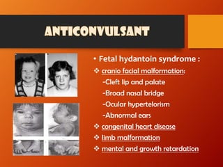 • Fetal hydantoin syndrome :
 cranio facial malformation:
-Cleft lip and palate
-Broad nasal bridge
-Ocular hypertelorism
-Abnormal ears
 congenital heart disease
 limb malformation
 mental and growth retardation
 