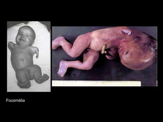 Focomélia
 