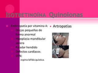  Embriopatía por vitamina A:
 Orejas pequeñas de
forma anormal
 Hipoplasia mandibular
severa
 Paladar hendido
 Defectos cardíacos
 DTN:
 espina bífida quística.
 Artropatías
 