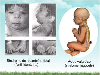 Síndrome de hidantoína fetal
(fenilhidantoína)

Ácido valproico
(mielomeningocele)

 