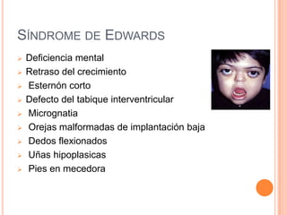 SÍNDROME DE EDWARDS
   Deficiencia mental
   Retraso del crecimiento
   Esternón corto
   Defecto del tabique interventricular
   Micrognatia
   Orejas malformadas de implantación baja
   Dedos flexionados
   Uñas hipoplasicas
   Pies en mecedora
 