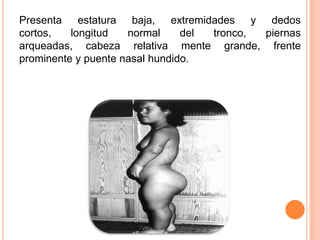 Presenta estatura baja, extremidades y dedos
cortos,   longitud   normal     del tronco, piernas
arqueadas, cabeza relativa mente grande, frente
prominente y puente nasal hundido.
 