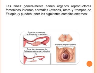 Las niñas generalmente tienen órganos reproductores
femeninos internos normales (ovarios, útero y trompas de
Falopio) y pueden tener los siguientes cambios externos:
 