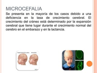 MICROCEFALIA
Se presenta en la mayoría de los casos debido a una
deficiencia en la tasa de crecimiento cerebral. El
crecimiento del cráneo está determinado por la expansión
cerebral que tiene lugar durante el crecimiento normal del
cerebro en el embarazo y en la lactancia.
 