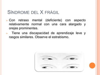 SÍNDROME DEL X FRÁGIL
   Con retraso mental (deficiente) con aspecto
    relativamente normal con una cara alargado y
    orejas prominentes.
     Tiene una discapacidad de aprendizaje leve y
    rasgos similares. Observe el estrabismo.
 