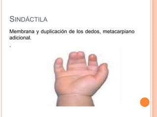SINDÁCTILA
Membrana y duplicación de los dedos, metacarpiano
adicional.
.
 