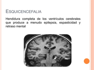 ESQUICENCEFALIA
Hendidura completa de los ventrículos cerebrales
que produce a menudo epilepsia, espasticidad y
retraso mental
 