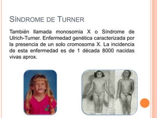 SÍNDROME DE TURNER
También llamada monosomia X o Síndrome de
Ulrich-Turner. Enfermedad genética caracterizada por
la presencia de un solo cromosoma X. La incidencia
de esta enfermedad es de 1 década 8000 nacidas
vivas aprox.
 