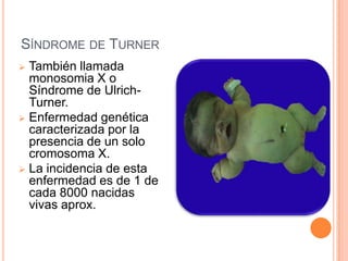 SÍNDROME DE TURNER
 También llamada
  monosomia X o
  Síndrome de Ulrich-
  Turner.
 Enfermedad genética
  caracterizada por la
  presencia de un solo
  cromosoma X.
 La incidencia de esta
  enfermedad es de 1 de
  cada 8000 nacidas
  vivas aprox.
 