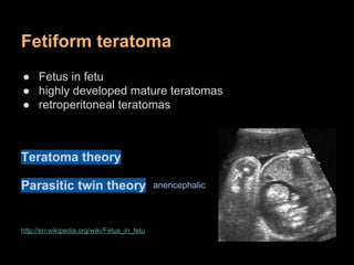 Fetiform teratoma
● Fetus in fetu
● highly developed mature teratomas
● retroperitoneal teratomas
Teratoma theory
Parasiti...