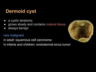 Dermoid cyst
● a cystic teratoma
● grows slowly and contains mature tissue
● always benign
rare malignant
in adult: squamo...