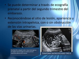 • Se puede determinar a través de ecografía
prenatal a partir del segundo trimestre del
embarazo.
• Reconociéndose el sitio de lesión, apariencia y
extensión intrapelvica, con o sin obstrucción
de las vías urinarias.
Eco fetal 2D y doppler color: masa heterogénea
en región sacrococcigea sin poder precisar
extensión pélvica de la misma. TERATOMA SACROCOCCIGEO TIPO II
 