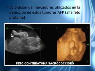 • Valoración de marcadores utilizados en la
detección de estos tumores AFP (alfa feto
proteína)
 